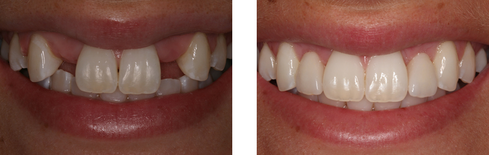Before and after implants image