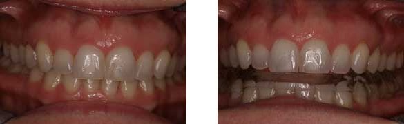 before-and-after-tmj appliance