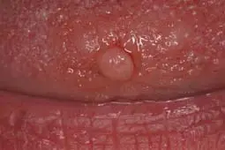 Laser removes fibroma in mouth