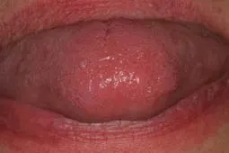 Laser removes fibroma on tongue