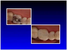 Before & After Dental Fillings