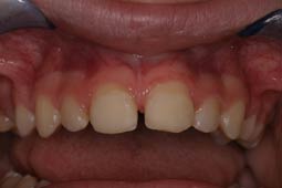 After Frenectomy with laser dentistry