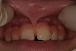 Before Frenectomy