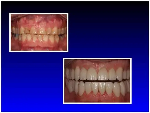Before and After Full Mouth Reconstruction
