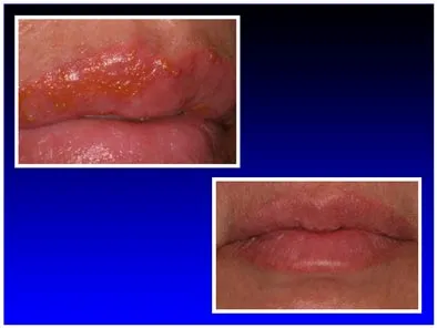 Before and After Photos, Laser Treatment for Herpetic Ulcer