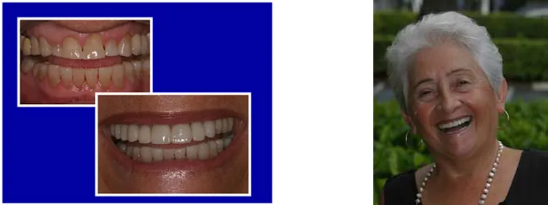 Minimally Invasive Dentistry: Before & After no-prep veneers (teeth were not reduced!)