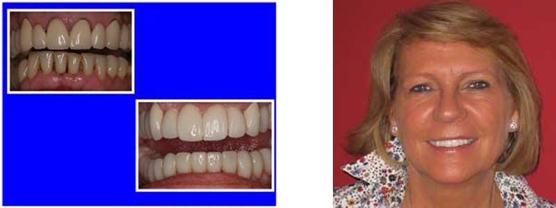 Before & After Veneers