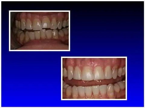 Before & After Invisalign Case Study 