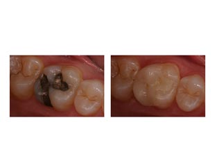 Replace old silver-mercury fillings with white composite fillings