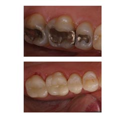 Replace Silver Fillings with White Fillings, Tooth Colored Restorations