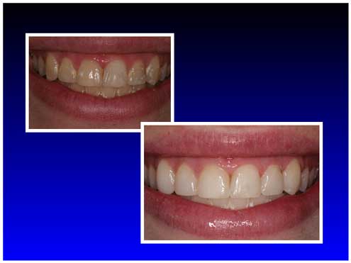 Before and After Teeth Whitening 