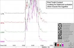 check first tooth contact graph