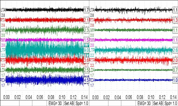 muscle activity before and after relaxation with TENS on chart