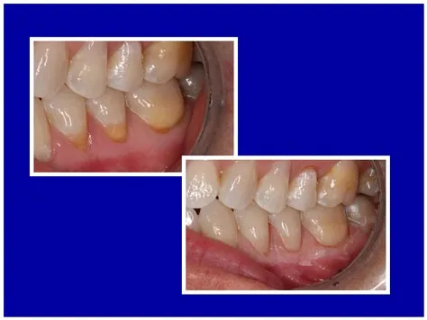 Tooth-colored fillings bonded to the teeth to repair abfractions at the gum line