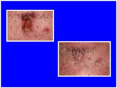 Before Laser Treatment and 4 Days After Laser Treatment Photos