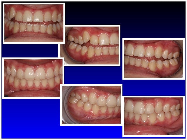 Before & After Teen Invisalign 