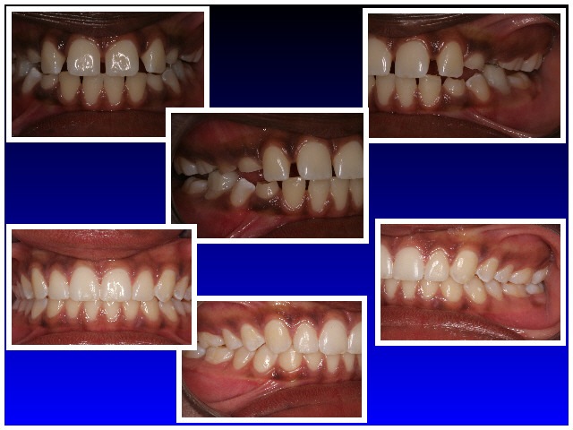Before & After Teen Invisalign 