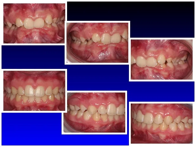 Before Treatment & After Treatment