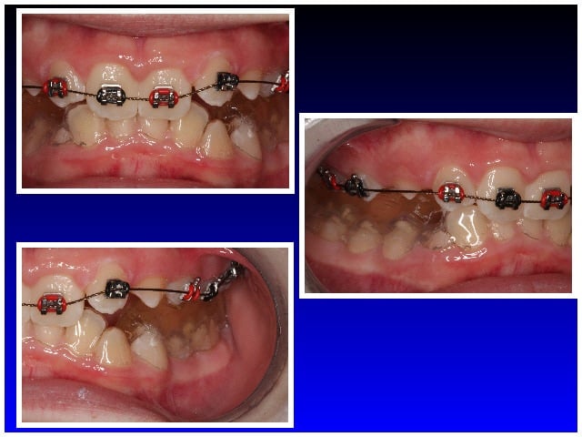During Braces Case #1
