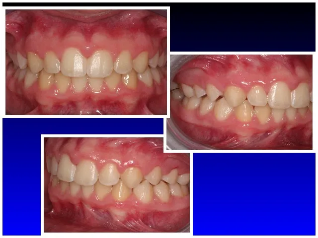 Completed treatment