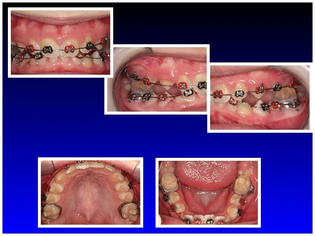 During Braces Case #2
