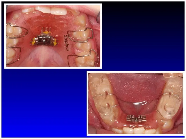 Expander on top with Orthotic on the bottom