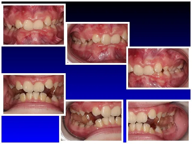 Before Treatment, and Wearing Lower Orthotic (on the Bottom) at Ideal Bite