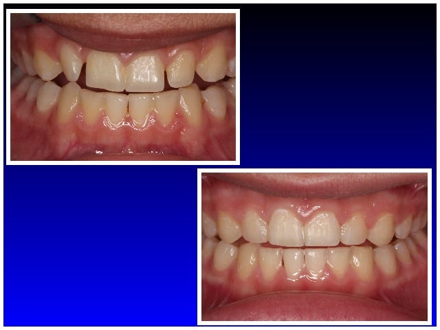 Before & After Braces