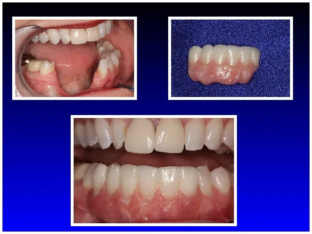 Before and after Oral Cancer & Dental Implant