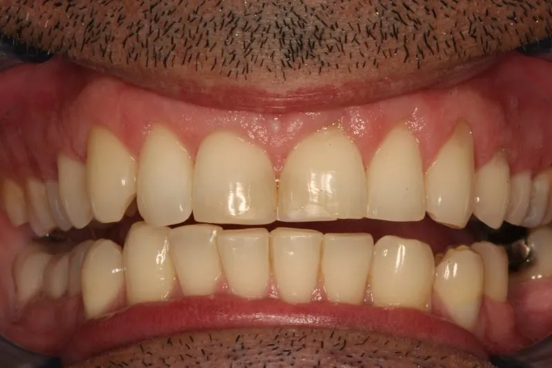 Before & After Laser Teeth Whitening