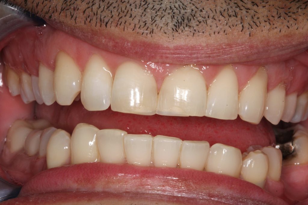 Before & After Laser Teeth Whitening