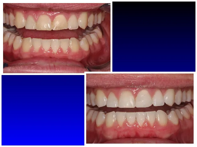 Before & After Laser Teeth Whitening