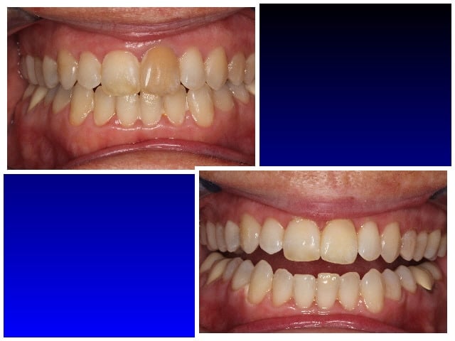 Before & After Laser Teeth Whitening