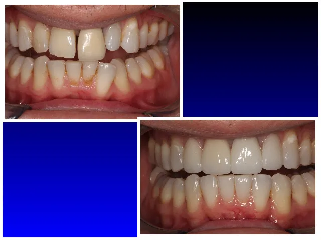 Before & After Invisalign with Porcelain Restorations