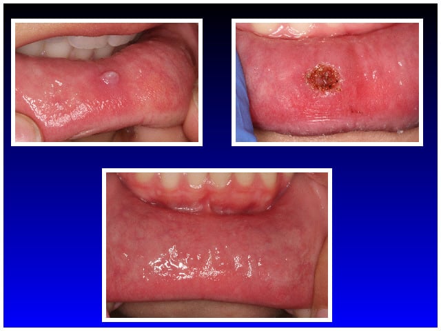 Before & After Mucocele Removal