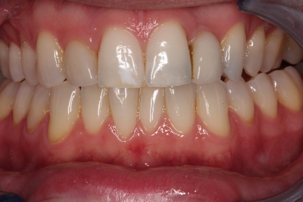 Before: A lateral Maryland Bridge that was too small and kept falling out