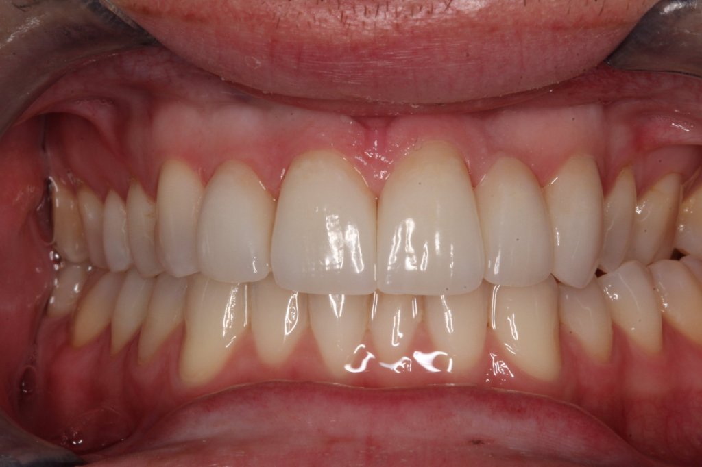 After:  A new, permanent Bridge and Veneers
