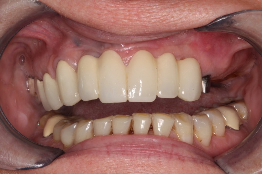 Before Locator Over Denture with Porcelain Restorations