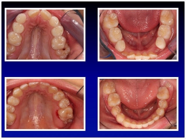 Before and After Braces