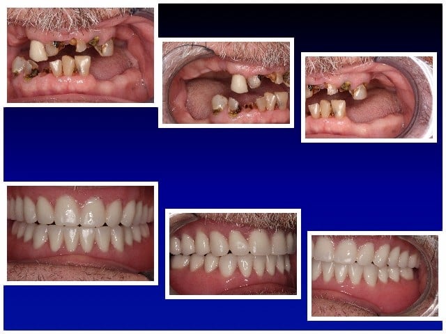 BEFORE & AFTER UPPER & LOWER DENTURES