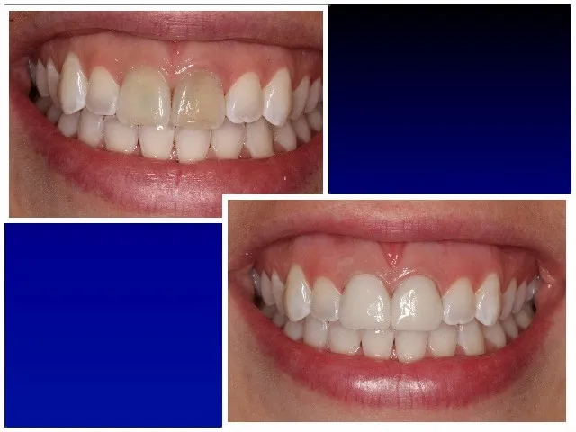 BEFORE & AFTER GALLERY: CEREC Crowns on Two Front Teeth