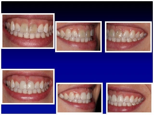 BEFORE & AFTER GALLERY: CEREC Crowns on Two Front Teeth