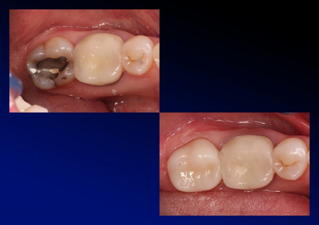 Replacing metal restorations with porcelain crowns