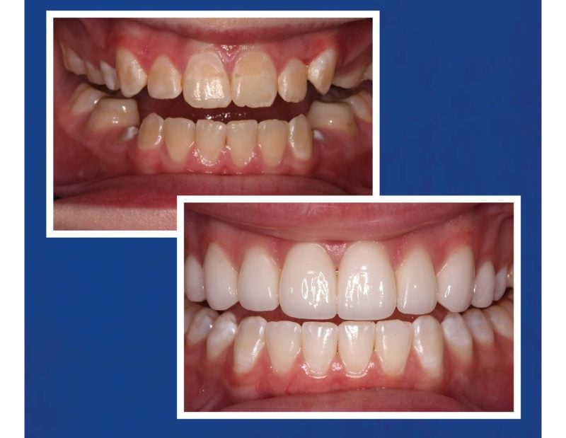 Before & After Veneers