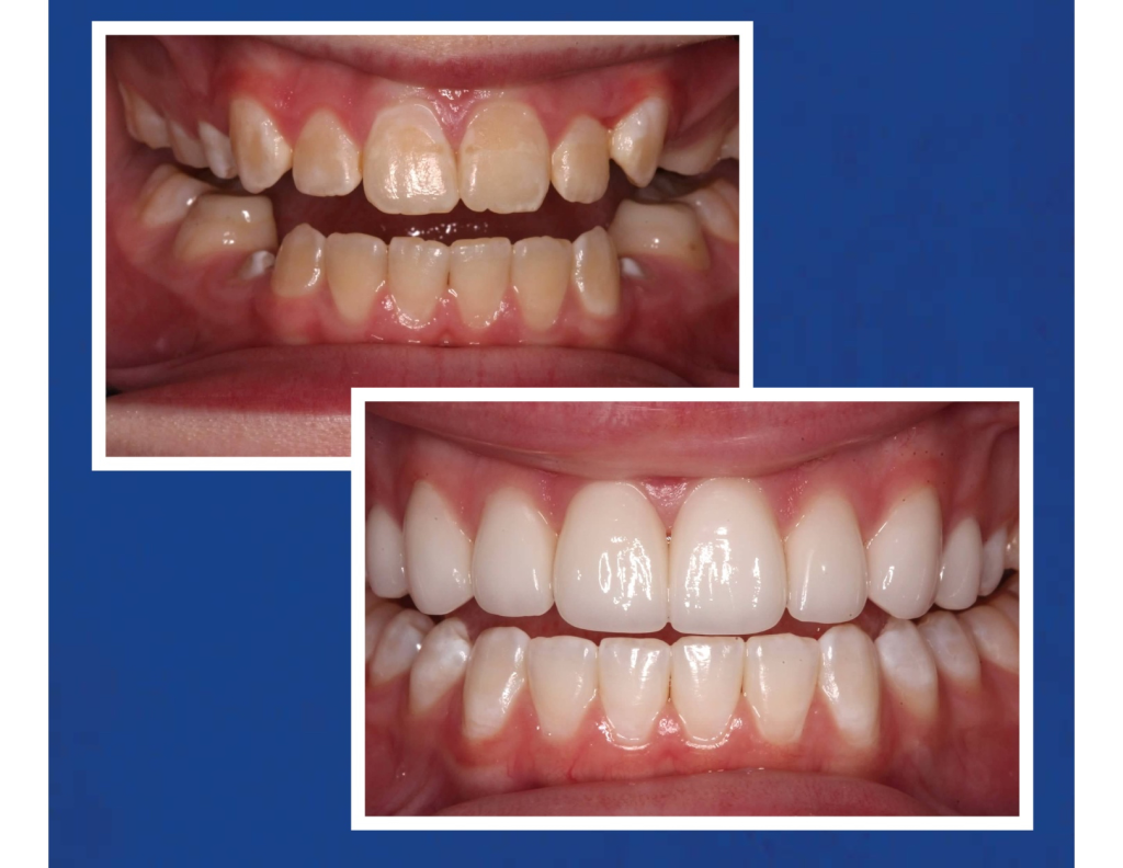 Before & After Veneers