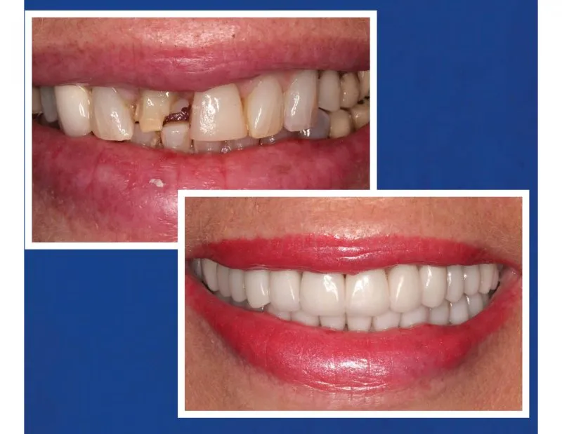 Before & After Full Mouth Reconstruction