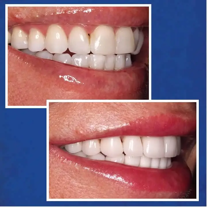 Before & After Porcelain Veneers