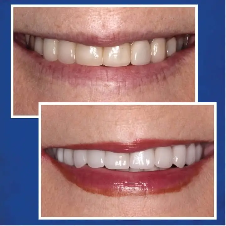 Before & After Veneers