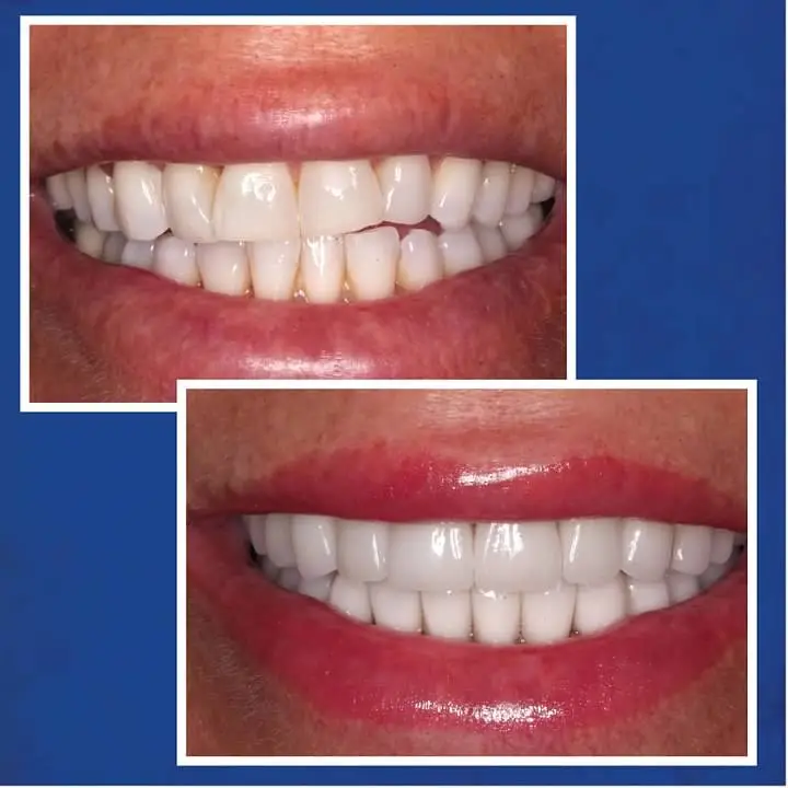 Before & After Porcelain Veneers