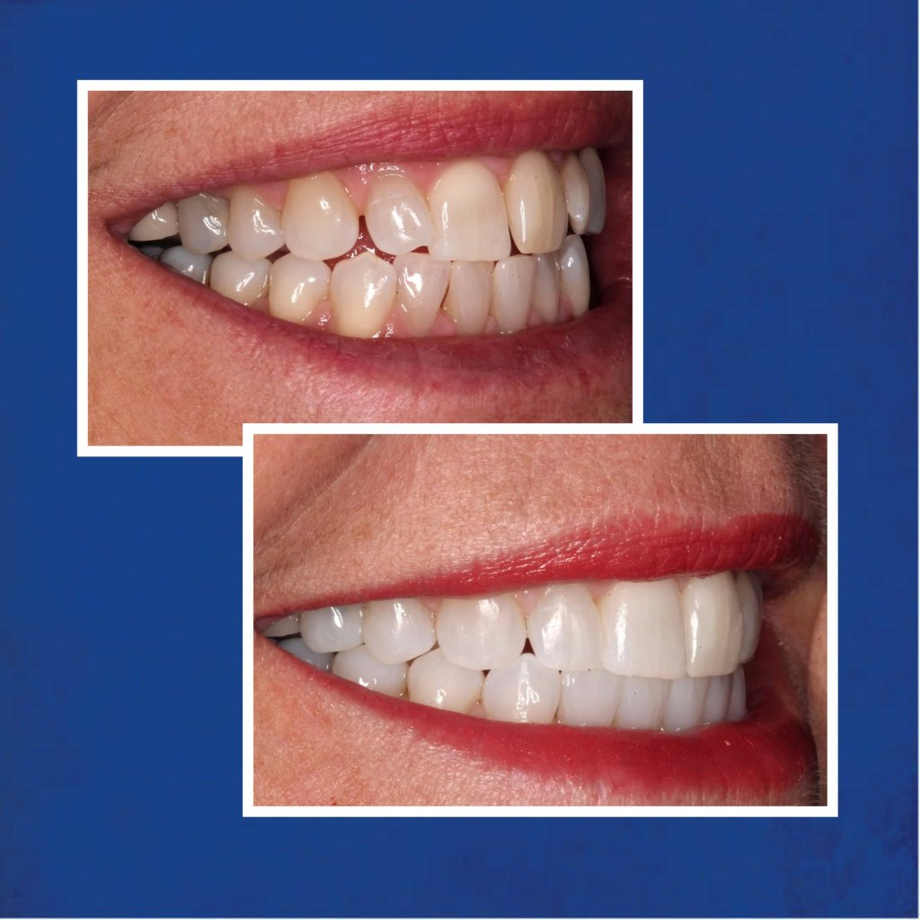 Before & After Invisalign